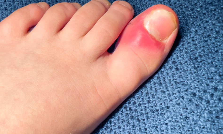 Ingrown Toenails Causes, Treatment, and Prevention